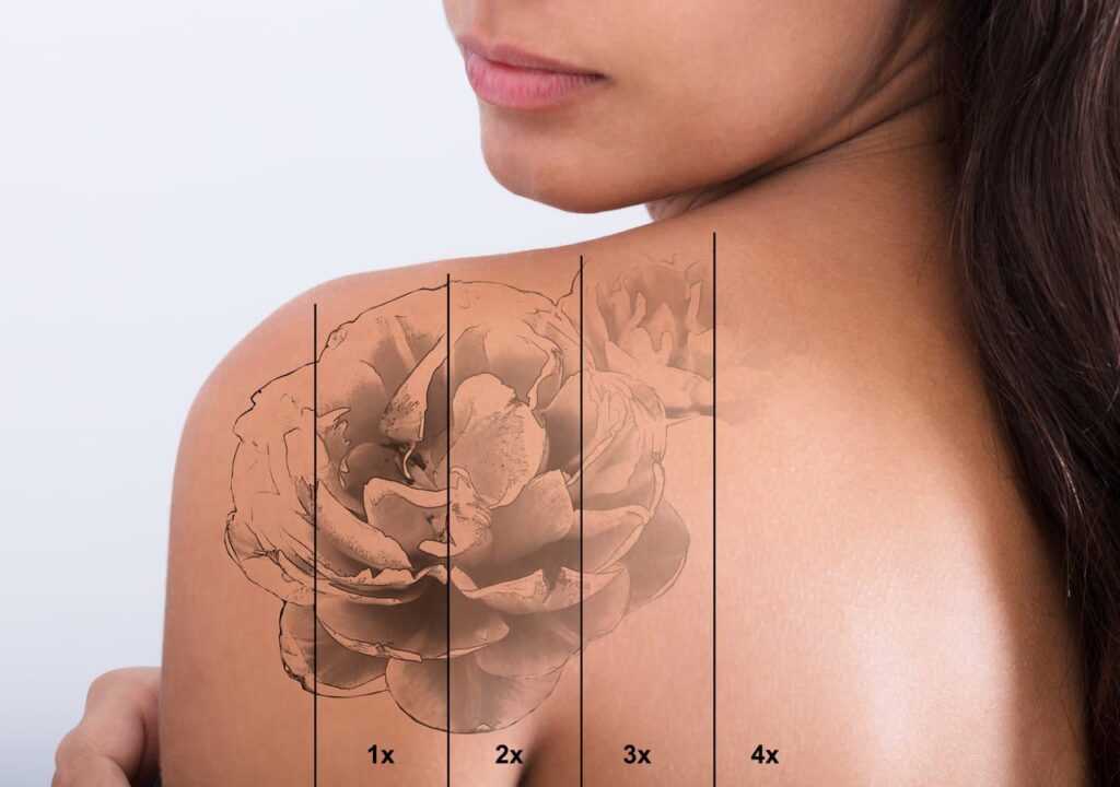 tattoo removal near me