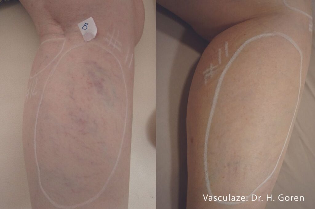 Vasculaze Treatment in Arlington VA at azure dream medspa