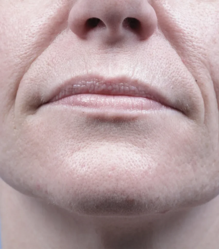 Forma-Skin-Tightening-before-Client