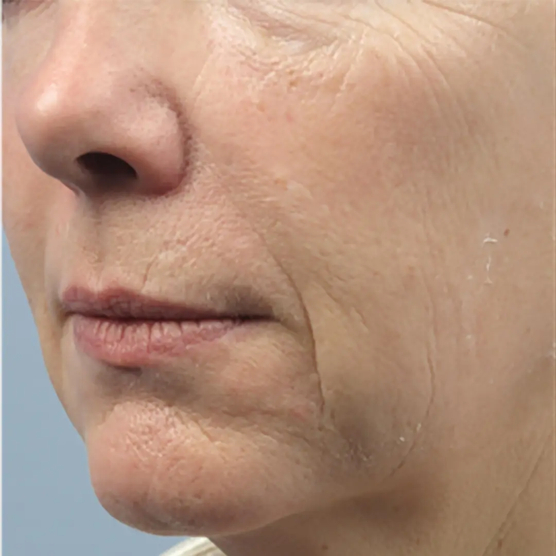 Forma before after picture of client at azure dream medspa in Arlington
