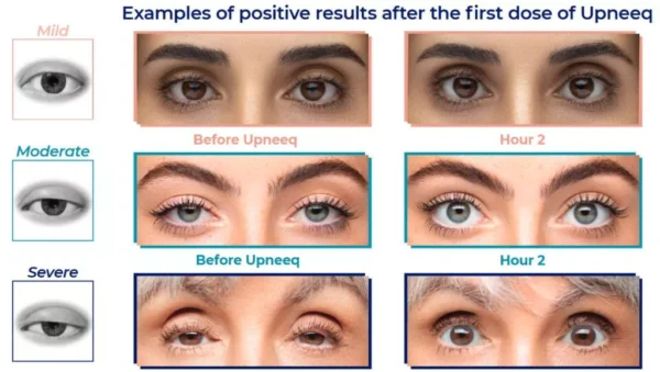 Upneeq Eye Drop - Image 2